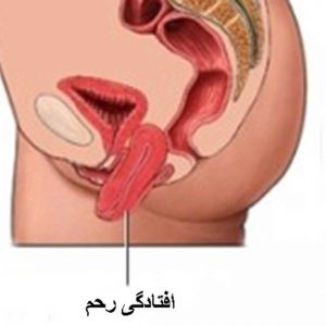 افتادگی-رحم
