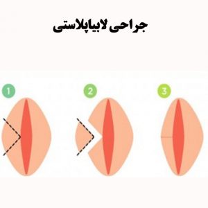جراحی-لابیاپلاستی