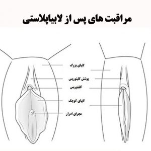 مراقبت-های-پس-از-لابیاپلاستی