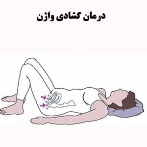 درمان-گشادی-واژن