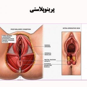 پرینوپلاستی