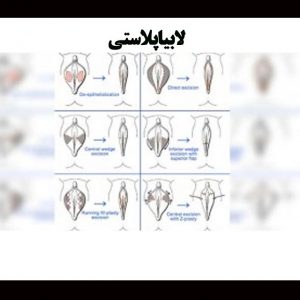 افراد-مناسب-لابیاپلاستی