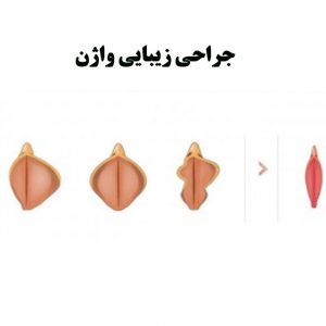 جراحی-زیبایی-واژن