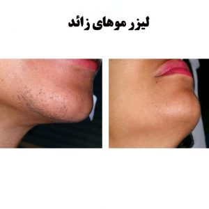 لیزر-موهای-زائد