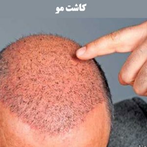 کاشت-مو
