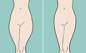 لیپوماتیک ران