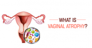 خشکی واژن در دوران یائسگی